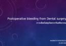 Postoperative bleeding from Dental surgery